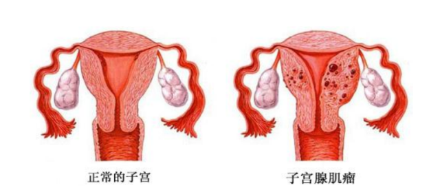 子宫腺肌症最新治疗方法探索，希望之光