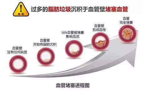 最新血管堵塞治疗方法的研究进展及成果概述